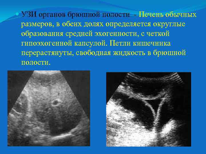  УЗИ органов брюшной полости - Печень обычных размеров, в обеих долях определяется округлые