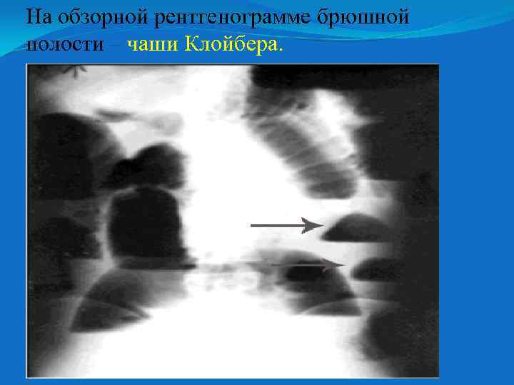На обзорной рентгенограмме брюшной полости – чаши Клойбера. 