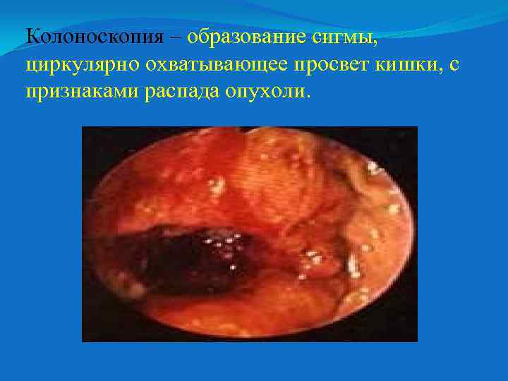 Колоноскопия – образование сигмы, циркулярно охватывающее просвет кишки, с признаками распада опухоли. 