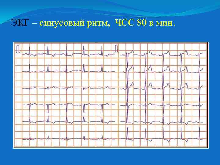 ЭКГ – синусовый ритм, ЧСС 80 в мин. 