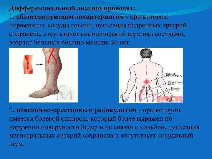 Дифференциальный диагноз проводят: 1. облитерирующим эндартериитом - при котором поражаются сосуды голени, пульсация бедренных