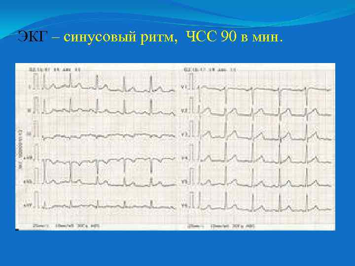 ЭКГ – синусовый ритм, ЧСС 90 в мин. 