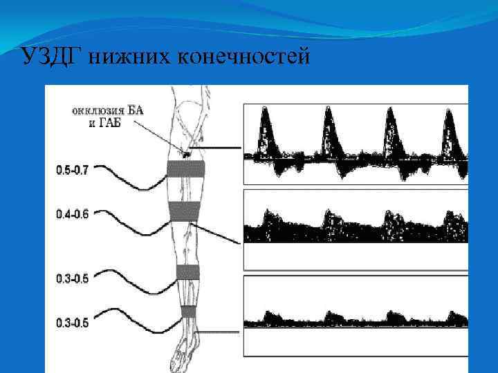 УЗДГ нижних конечностей 