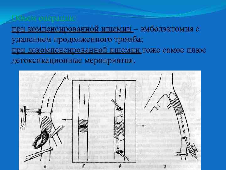 Объем операции: при компенсированной ишемии – эмболэктомия с удалением продолженного тромба; при декомпенсированной ишемии