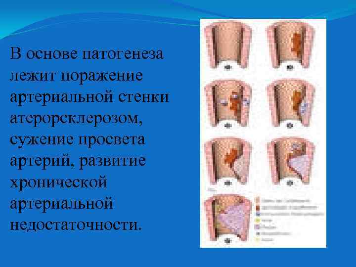 В основе патогенеза лежит поражение артериальной стенки атерорсклерозом, сужение просвета артерий, развитие хронической артериальной