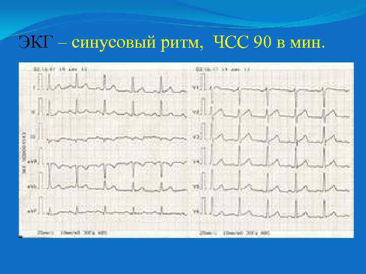 ЭКГ – синусовый ритм, ЧСС 90 в мин. 