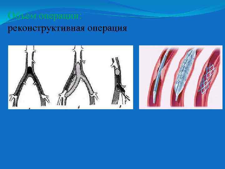 Объем операции: реконструктивная операция 