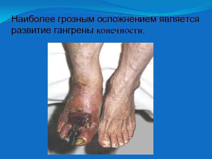 Наиболее грозным осложнением является развитие гангрены конечности. 