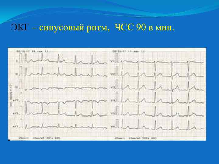 ЭКГ – синусовый ритм, ЧСС 90 в мин. 