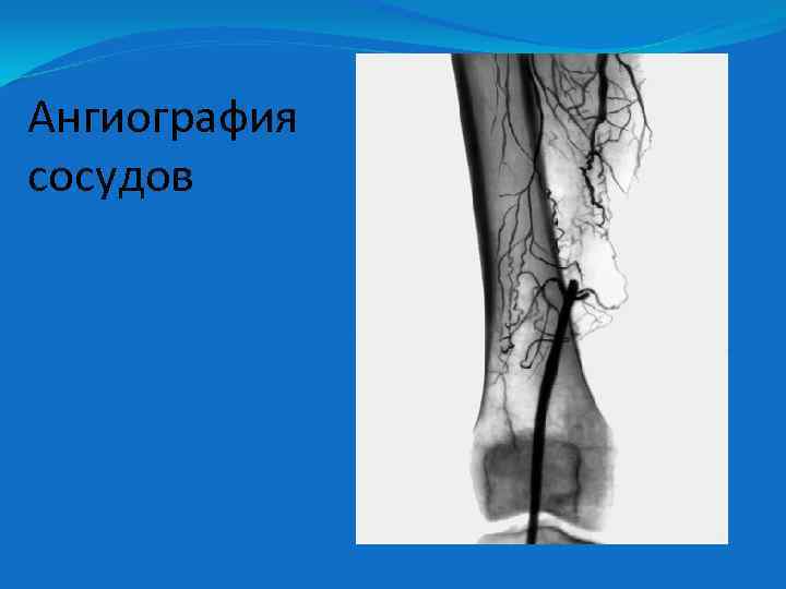 Ангиография сосудов 