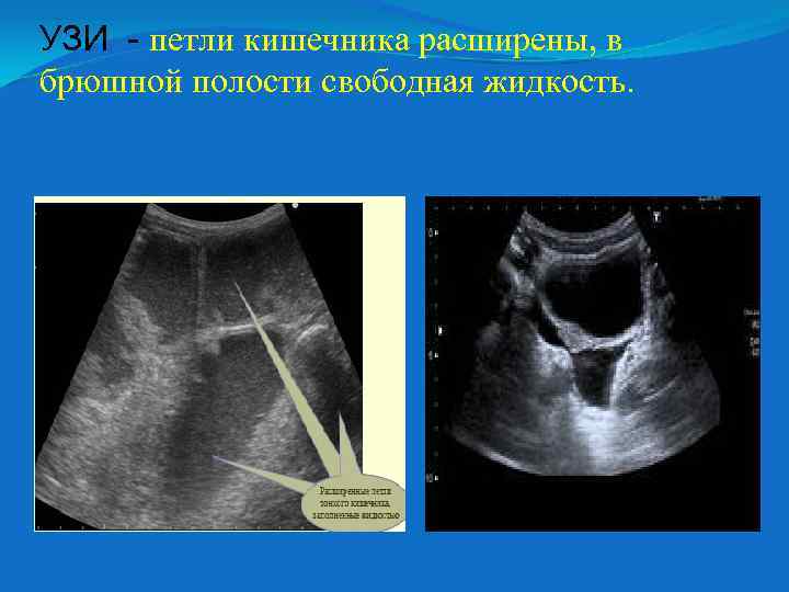 УЗИ - петли кишечника расширены, в брюшной полости свободная жидкость. 