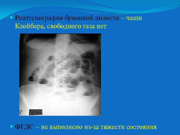  Рентгенография брюшной полости – чаши Клойбера, свободного газа нет ФГДС – не выполнено