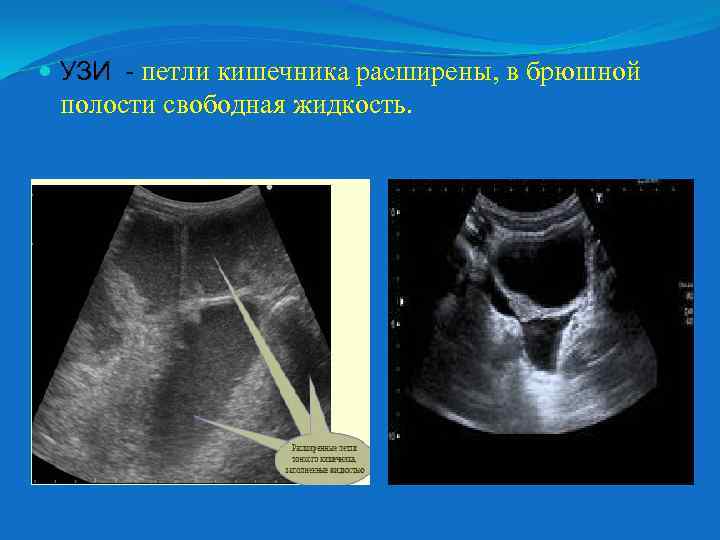  УЗИ - петли кишечника расширены, в брюшной полости свободная жидкость. 