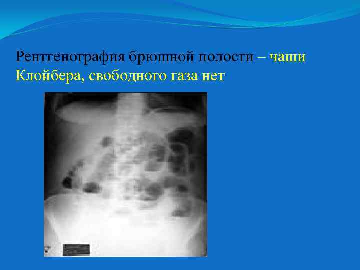 Рентгенография брюшной полости – чаши Клойбера, свободного газа нет 