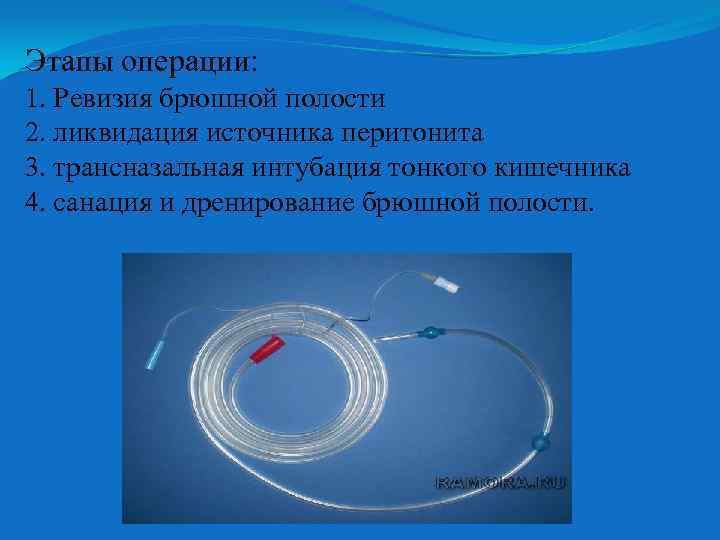 Этапы операции: 1. Ревизия брюшной полости 2. ликвидация источника перитонита 3. трансназальная интубация тонкого