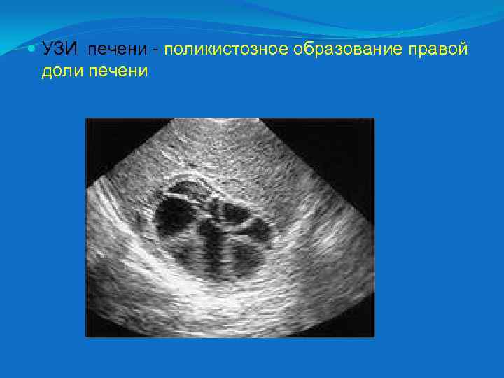  УЗИ печени - поликистозное образование правой доли печени 