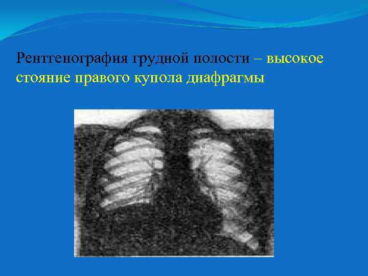 Рентгенография грудной полости – высокое стояние правого купола диафрагмы 