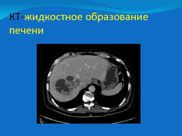 КТ-жидкостное образование печени 