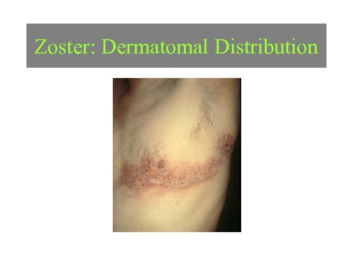 Zoster: Dermatomal Distribution Image courtesy of Charles E. Crutchfield III, MD. 
