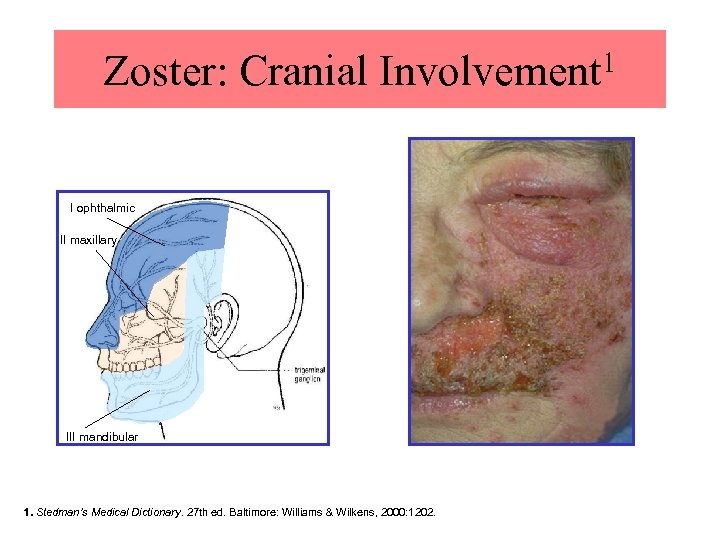 1 Zoster: Cranial Involvement I ophthalmic II maxillary III mandibular Reproduced with permission. 1