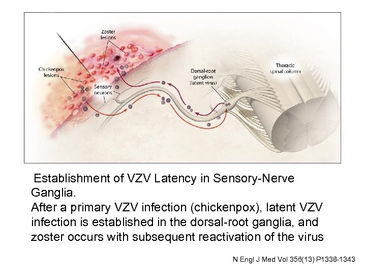  Establishment of VZV Latency in Sensory-Nerve Ganglia. After a primary VZV infection (chickenpox),