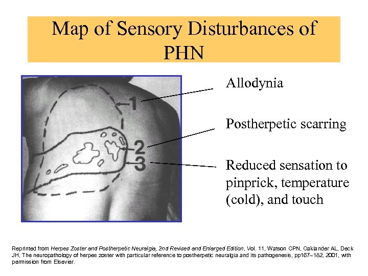 Map of Sensory Disturbances of PHN • Allodynia • Postherpetic scarring • Reduced sensation