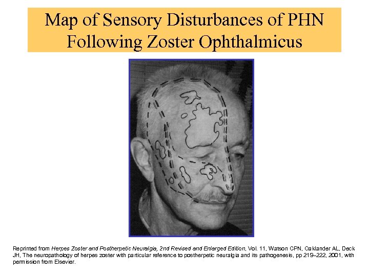 Map of Sensory Disturbances of PHN Following Zoster Ophthalmicus Reprinted from Herpes Zoster and