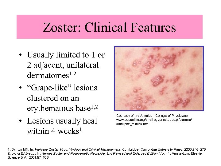 Zoster: Clinical Features • Usually limited to 1 or 2 adjacent, unilateral dermatomes 1,