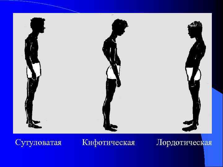 Сутуловатая Кифотическая Лордотическая 