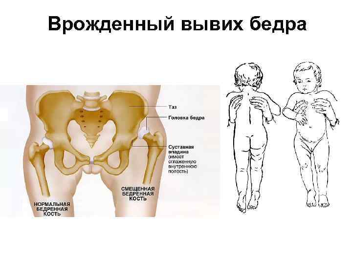 Врожденный вывих бедра 