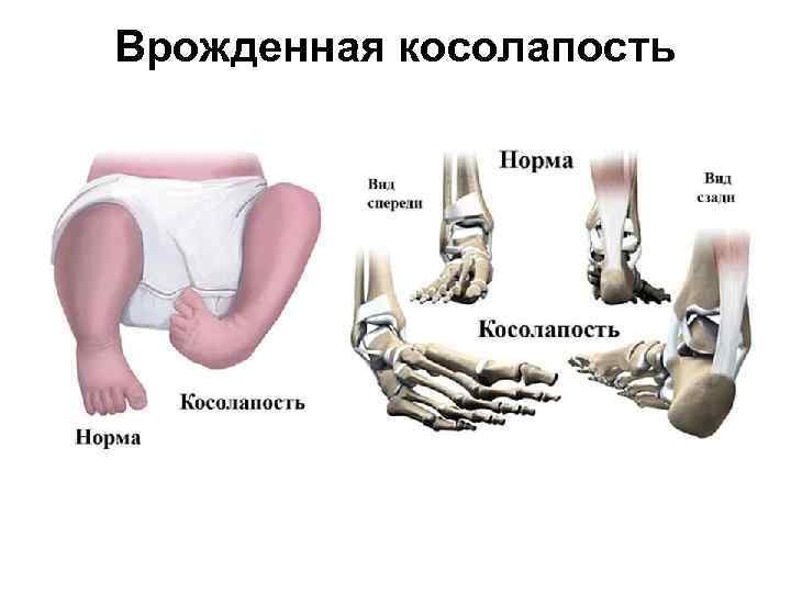 Врожденная косолапость 