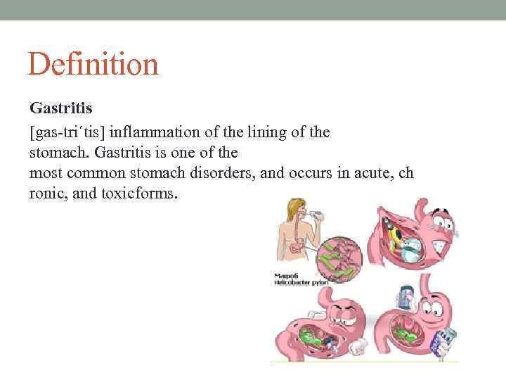 Definition Gastritis [gas-tri´tis] inflammation of the lining of the stomach. Gastritis is one of