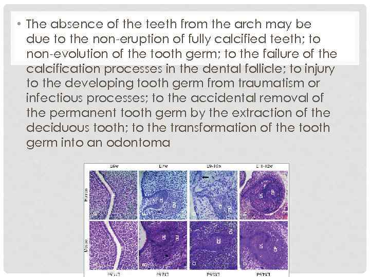  • The absence of the teeth from the arch may be due to