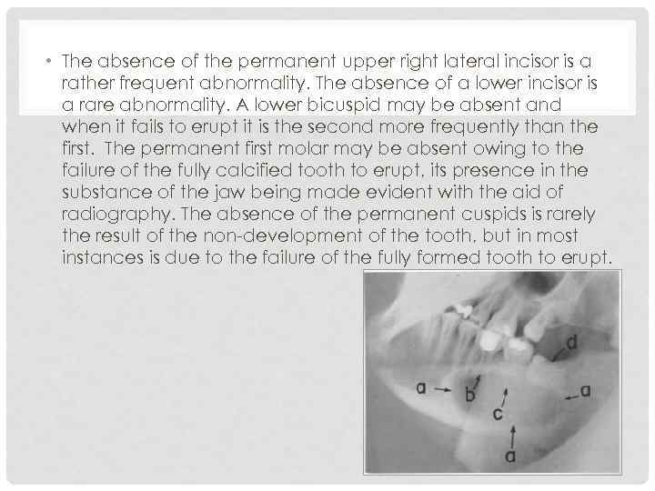  • The absence of the permanent upper right lateral incisor is a rather