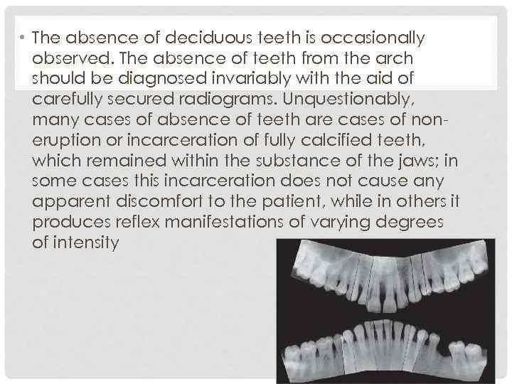  • The absence of deciduous teeth is occasionally observed. The absence of teeth