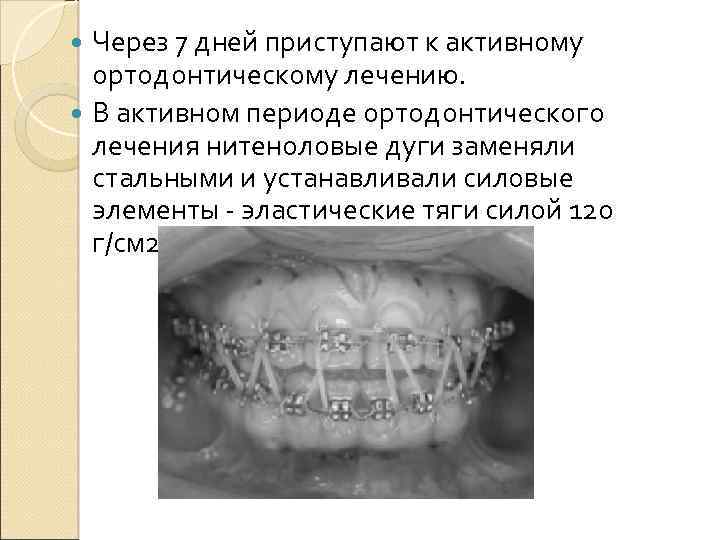 Через 7 дней приступают к активному ортодонтическому лечению. В активном периоде ортодонтического лечения нитеноловые
