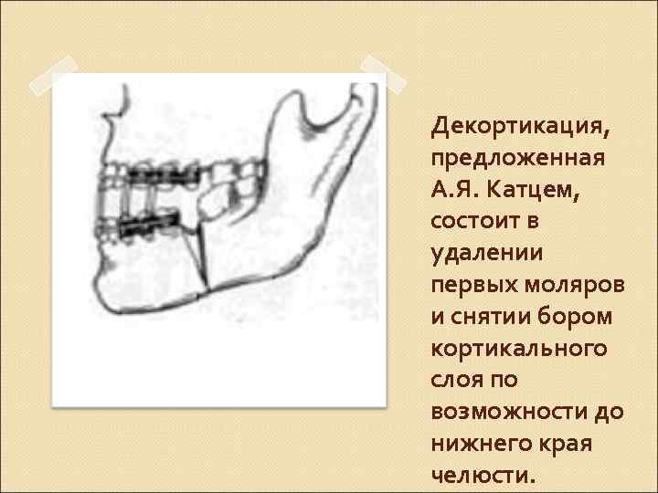 Декортикация, предложенная А. Я. Катцем, состоит в удалении первых моляров и снятии бором кортикального