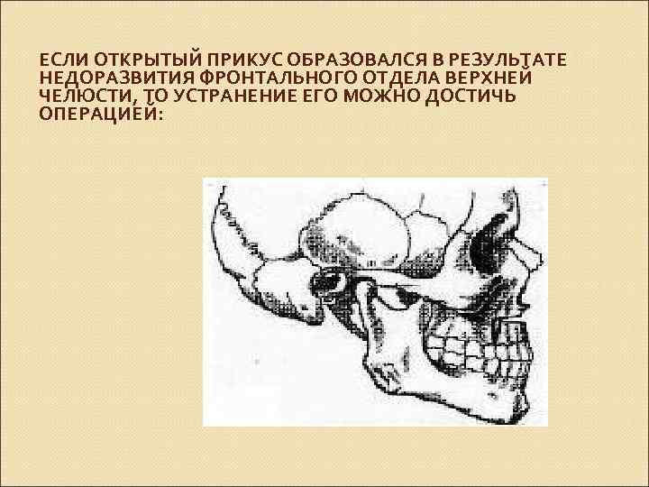 ЕСЛИ ОТКРЫТЫЙ ПРИКУС ОБРАЗОВАЛСЯ В РЕЗУЛЬТАТЕ НЕДОРАЗВИТИЯ ФРОНТАЛЬНОГО ОТДЕЛА ВЕРХНЕЙ ЧЕЛЮСТИ, ТО УСТРАНЕНИЕ ЕГО