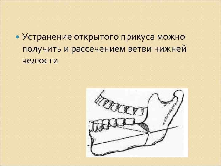  Устранение открытого прикуса можно получить и рассечением ветви нижней челюсти 