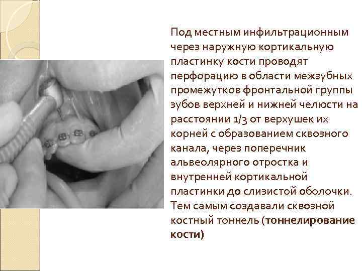 Под местным инфильтрационным через наружную кортикальную пластинку кости проводят перфорацию в области межзубных промежутков