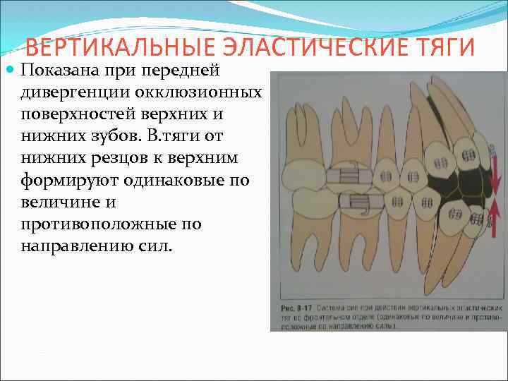 ВЕРТИКАЛЬНЫЕ ЭЛАСТИЧЕСКИЕ ТЯГИ Показана при передней дивергенции окклюзионных поверхностей верхних и нижних зубов. В.