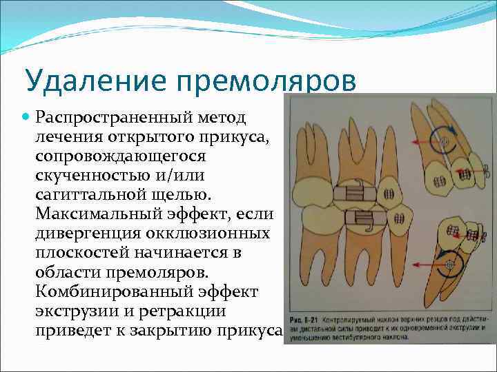 Удаление премоляров Распространенный метод лечения открытого прикуса, сопровождающегося скученностью и/или сагиттальной щелью. Максимальный эффект,