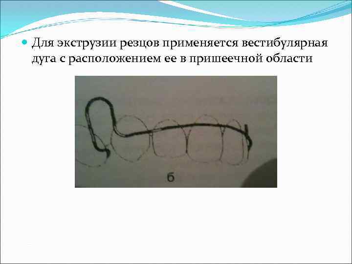  Для экструзии резцов применяется вестибулярная дуга с расположением ее в пришеечной области 