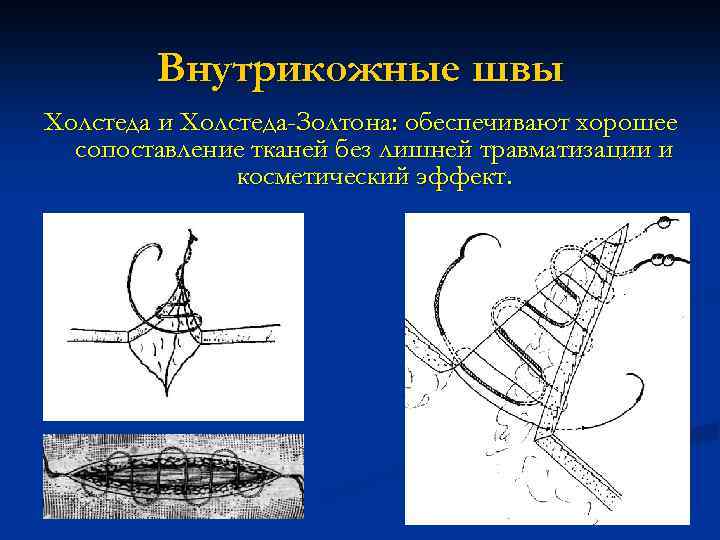 Внутрикожные швы Холстеда и Холстеда-Золтона: обеспечивают хорошее сопоставление тканей без лишней травматизации и косметический