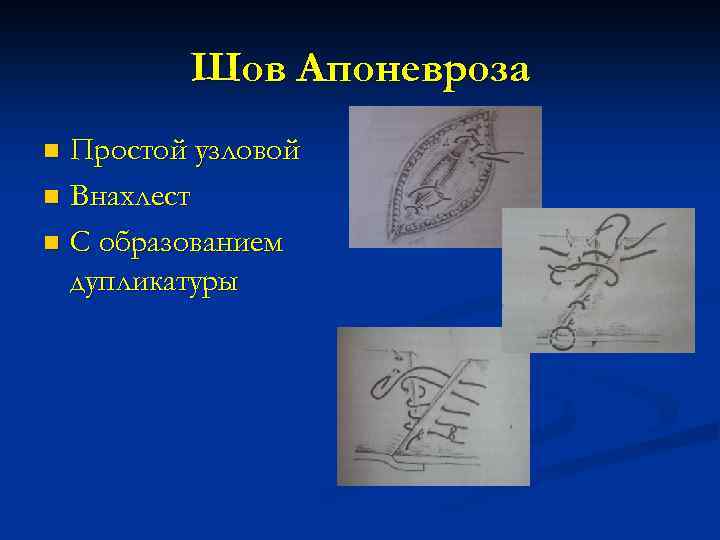 Шов Апоневроза Простой узловой n Внахлест n С образованием дупликатуры n 