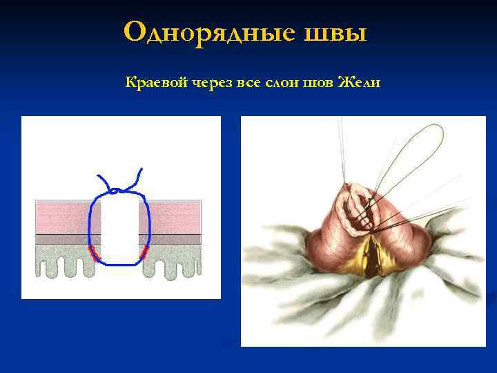 Однорядные швы Краевой через все слои шов Жели 