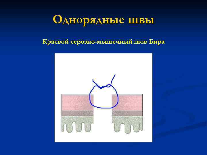 Однорядные швы Краевой серозно-мышечный шов Бира 