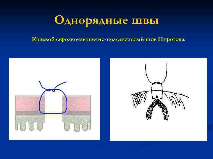 Однорядные швы Краевой серозно-мышечно-подслизистый шов Пирогова 