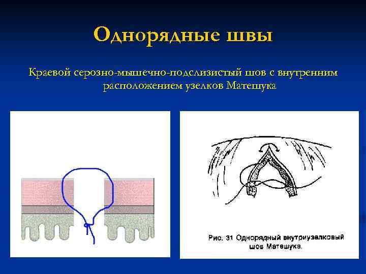 Однорядные швы Краевой серозно-мышечно-подслизистый шов с внутренним расположением узелков Матешука 