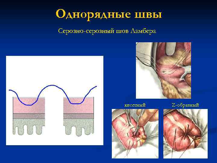 Однорядные швы Серозно-серозный шов Ламбера кисетный Z-образный 